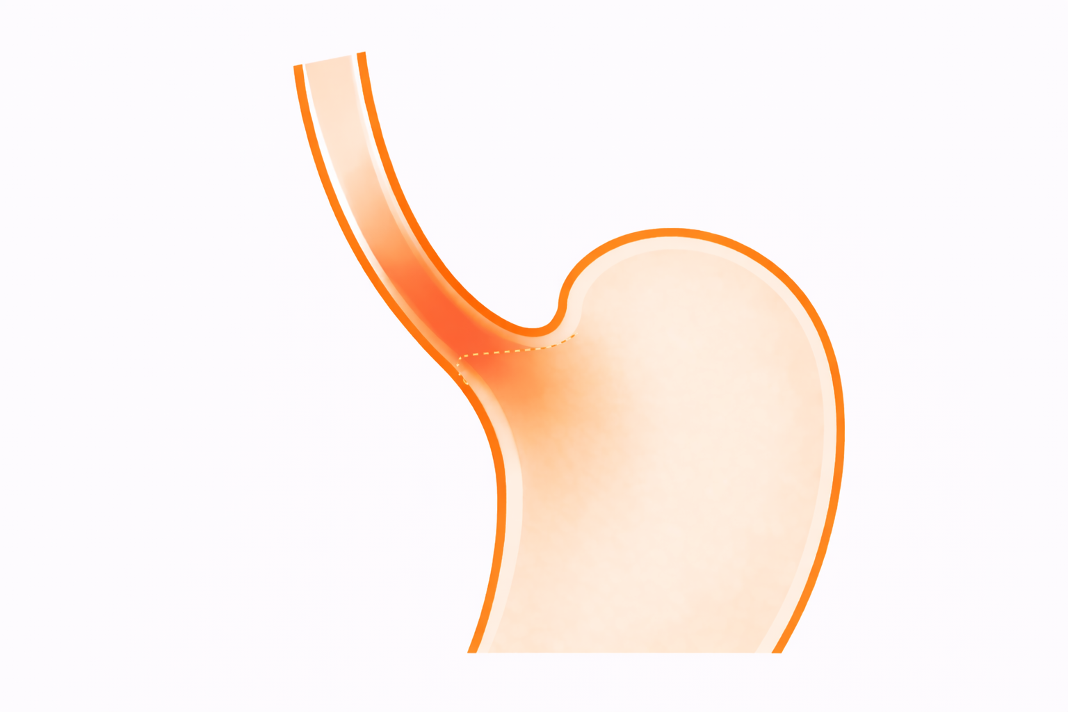 バレット食道とは？｜食道がんとの関係と胃カメラの重要性【医療コラム第72回】