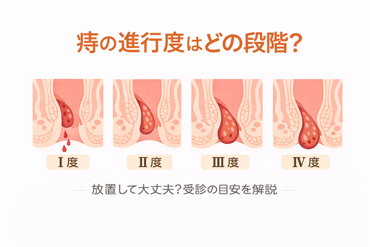 内痔核の進行度(I〜IV)とは?|症状と治療の選び方【医療コラム第83回】