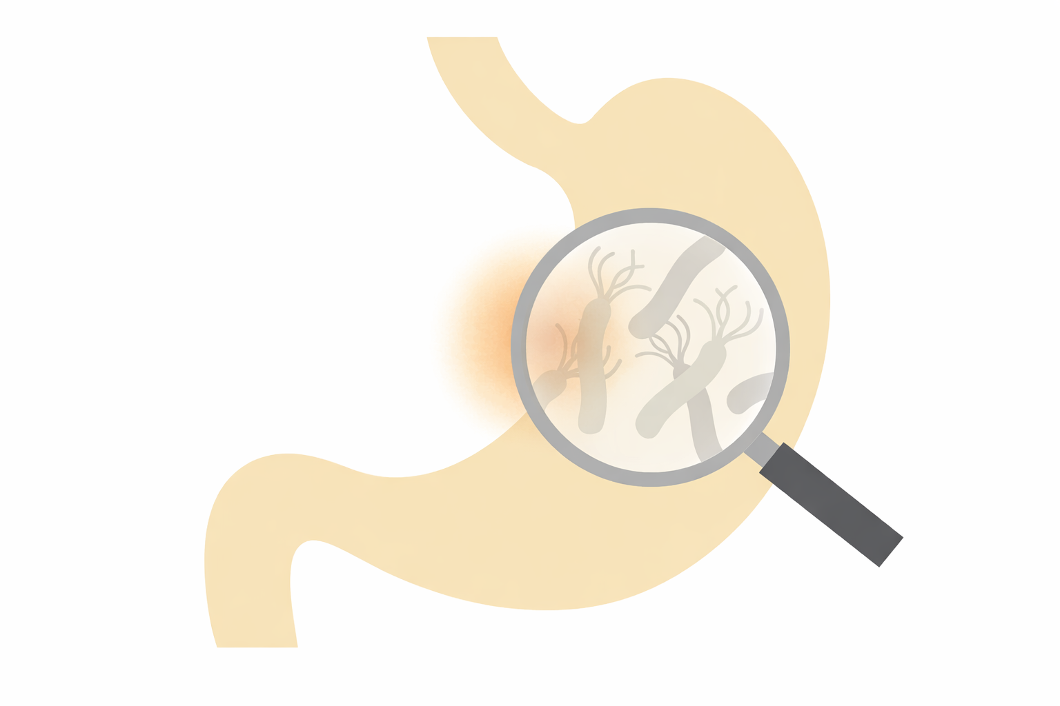 ピロリ菌と胃がんの関係｜感染しているとどうなる？除菌の重要性を解説【医療コラム第92回】
