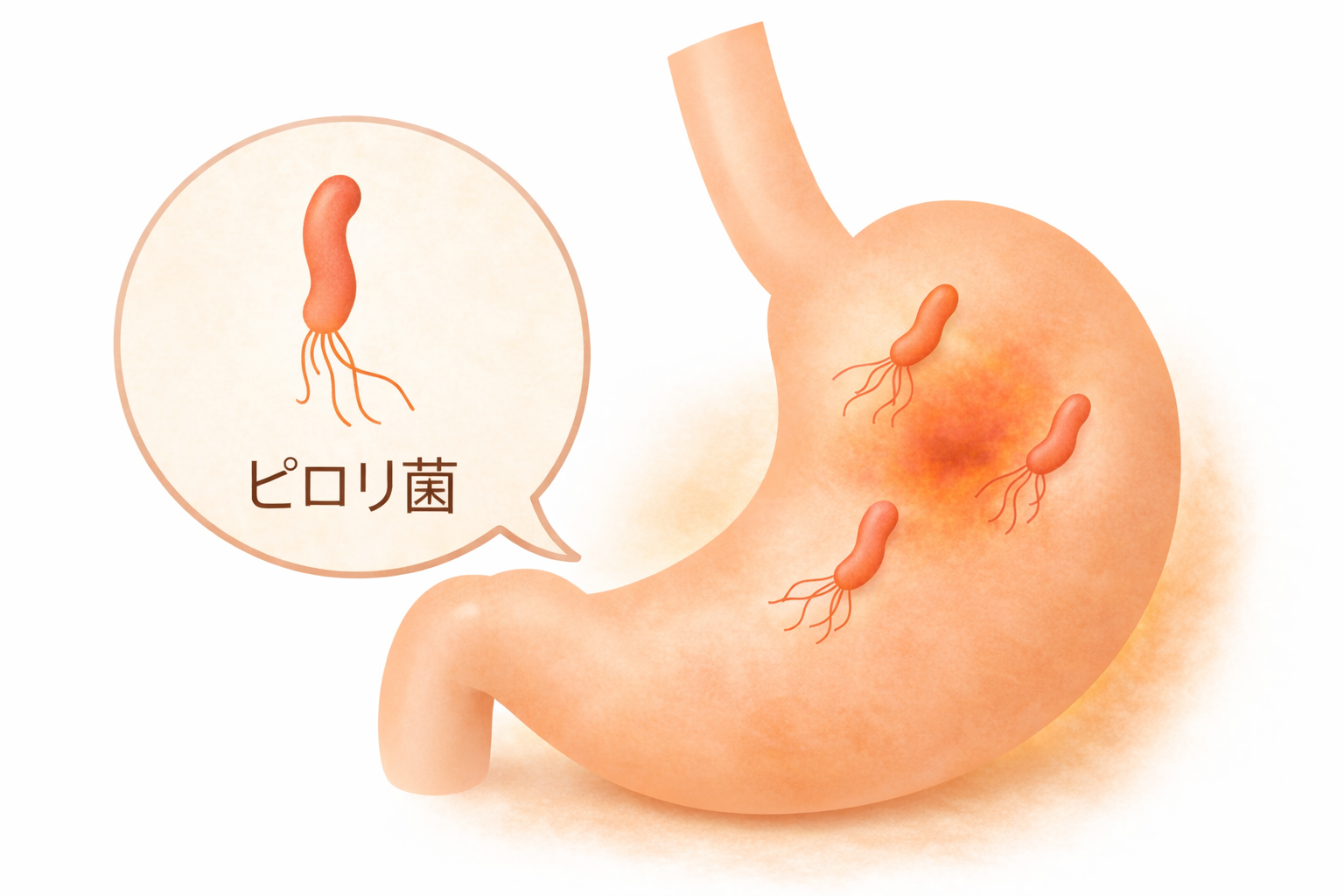 ピロリ菌と言われたら｜検査で指摘されたときの意味と次にやるべきこと【医療コラム第25回】